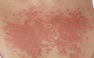 Аллергия на солнце — что делать? Симптомы и лечение.