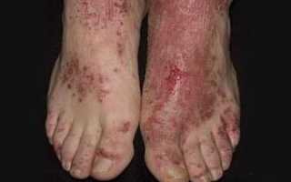 Экзема на ногах – фото, симптомы и лечение