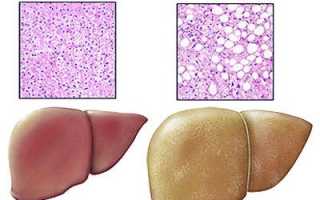 Жировой гепатоз печени: симптомы, лечение и диета