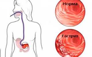 Гастрит – симптомы и лечение, признаки гастрита желудка