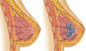 Инвазивный рак молочной железы