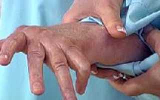 Ревматоидный артрит – симптомы и лечение, народные средства