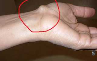 Гигрома на запястье руки – что это такое и как лечить?