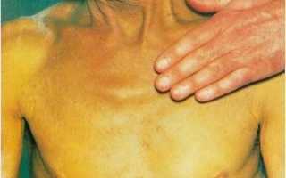 Цирроз печени – симптомы, причины и лечение