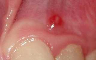 Киста на корне зуба – симптомы, лечение, удаление