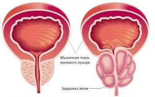 Аденома предстательной железы: симптомы и лечение