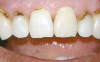 Кариес зубов – фото, профилактика и лечение