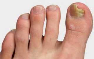 Чем лечить грибок ногтей на ногах? Отзывы!