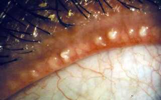 Блефарит – что это такое? Лечение, симптомы и фото глаза
