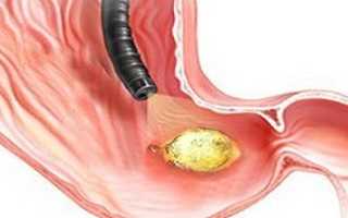 Прободная язва желудка – причины, симптомы и лечение