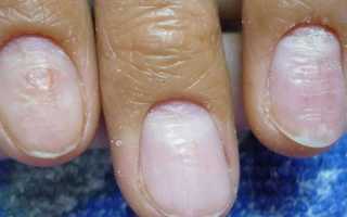 Как убрать грибок на ногтях рук