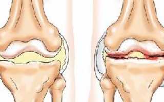 Артроз: что это такое, и как лечить пораженные суставы?