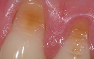 Клиновидный дефект зубов – причины и лечение