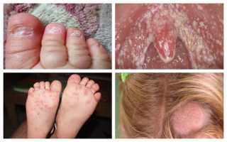 Грибковые заболевания кожи у детей