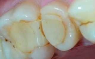 Что делать, если болит зуб после пломбирования?