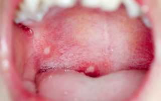 Детская молочница во рту как лечить