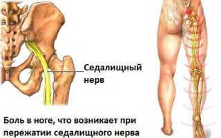 Защемление, воспаление седалищного нерва – симптомы и лечение