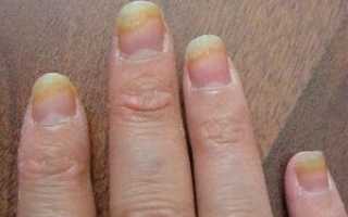 Грибок ногтей на руках фото начальная лечение