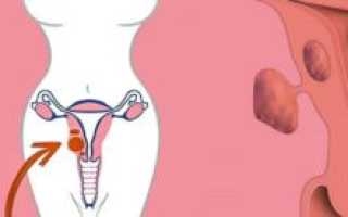 Методы лечения миомы матки без операции