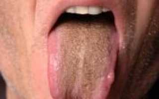 Почему появляется коричневый налет на языке?