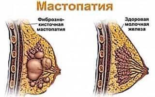 Диффузная мастопатия симптомы