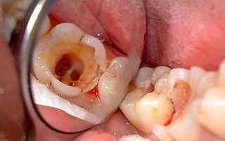 Пульпит зуба – что это такое? Симптомы и лечение