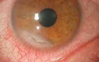 Кератит глаза – фото, признаки и современные способы лечения