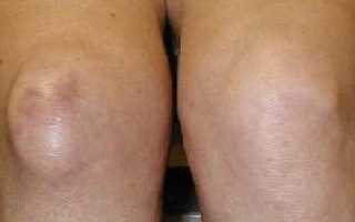 Бурсит коленного сустава – симптомы и лечение в домашних условиях