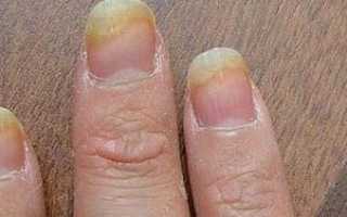 Чем лечить грибок ногтей на руках?