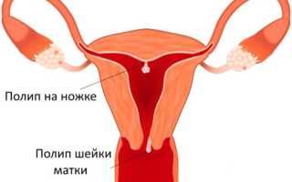 Виды полипов эндометрия матки