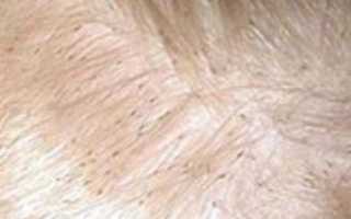 Зуд кожи головы – причины и лечение проблемы