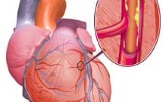 Ишемическая болезнь сердца: симптомы, причины и лечение