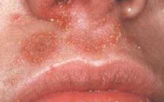 Как лечить стафилококк в носу и горле
