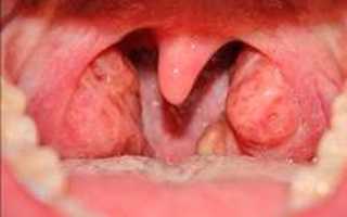 Золотистый стафилококк в горле: симптомы и лечение