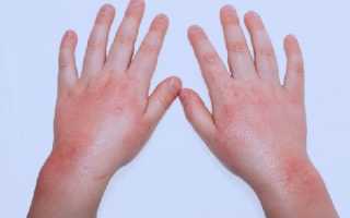 Как проявляется дерматит на руках: фото, симптомы и способы лечения