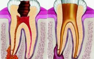 Периодонтит зуба – причины, симптомы и лечение