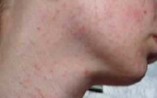 Сыпь на лице в виде мелких прыщиков: причины и лечение