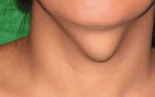 Киста щитовидной железы, что это такое и как лечить?