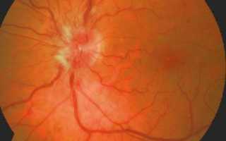 Что такое неврит зрительного нерва: симптомы и лечение
