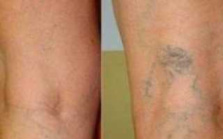 Варикозное расширение вен на ногах: симптомы и лечение