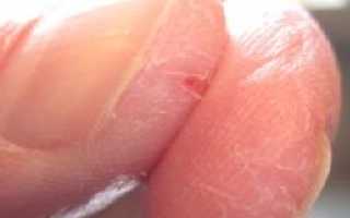 Трещины на пальцах рук возле ногтей: причины, лечение