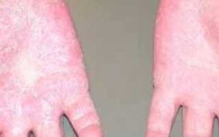 Аллергия на холод на лице и руках — симптомы и лечение, фото