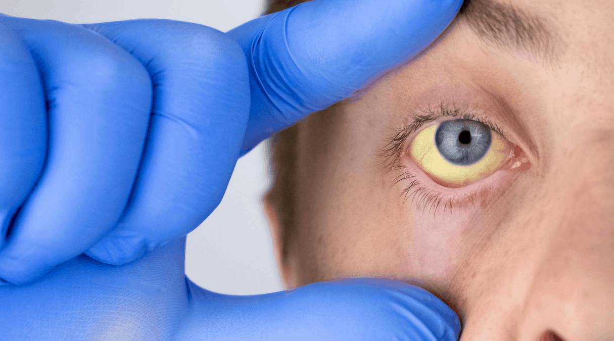 Симптома фиброза 4 стадии Симптомы фиброза 4 степени