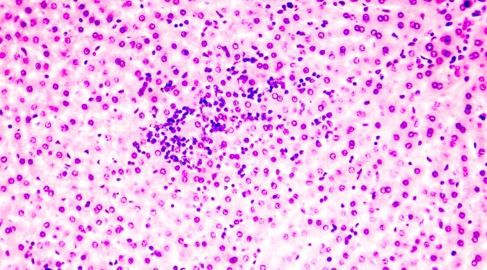 Фиброз 1-2 стадии