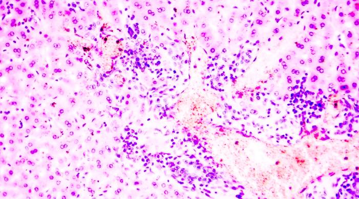 Фиброз печени и гепатит С. Симптомы.