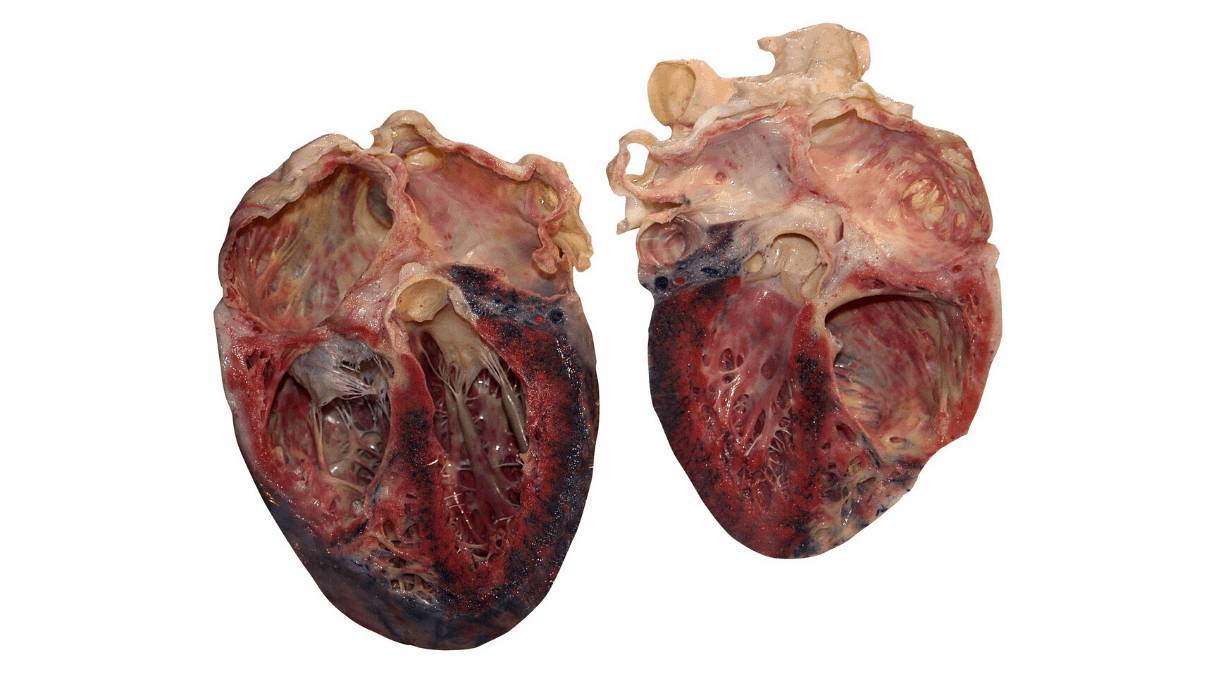 Сердце при гепатите С Влияние гепатита С на сердце