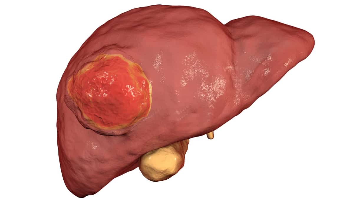 Опухоли печени: причины, симптомы, диагностика