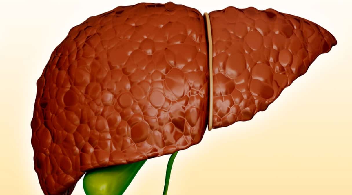 цирроз печени фиброз печени