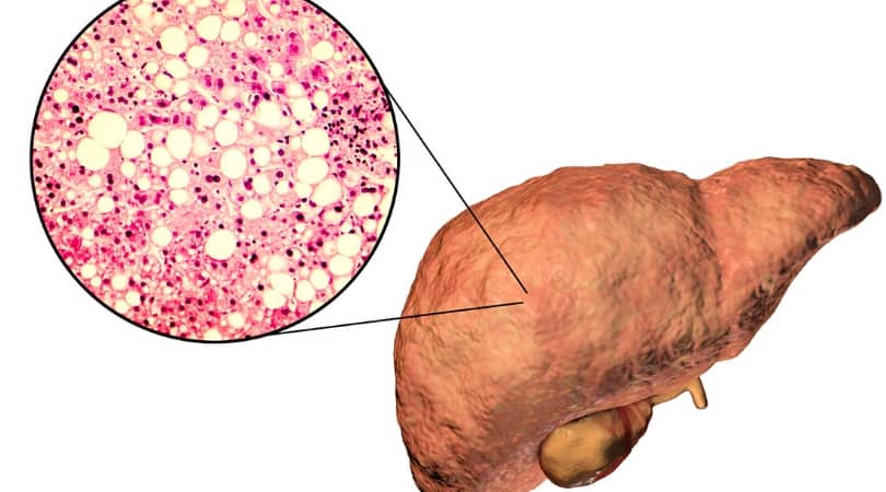 алкоголь вызывает цирроз печени алкоголь при ВИЧ влияет на цирроз печени