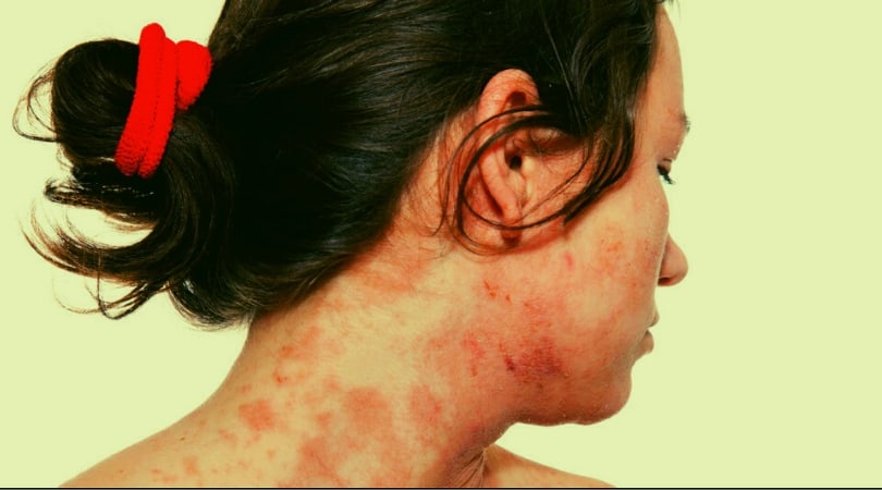 Симптомы ВИЧ у женщин